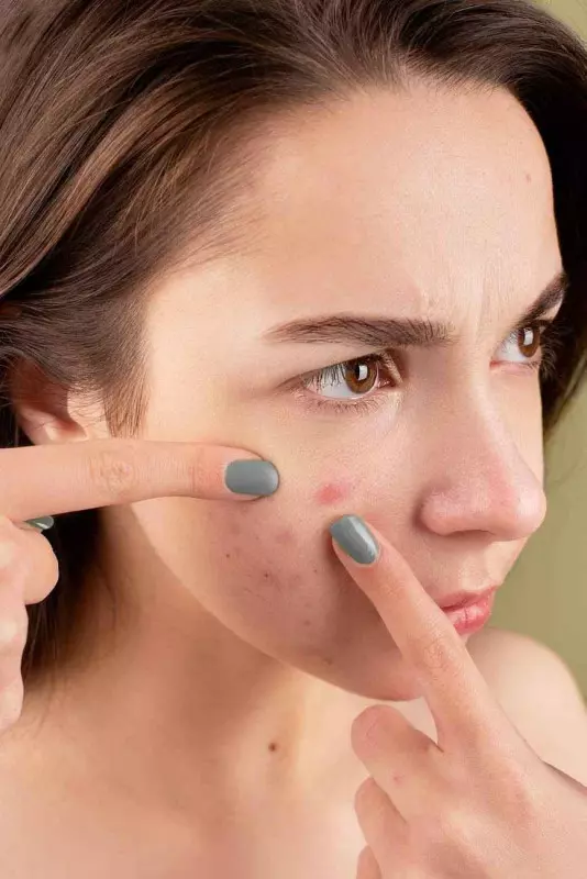 How to Get Rid of Acne Once and For All